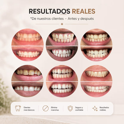 Sereno White™ – Blanquea tus dientes desde casa en 10–15 minutos al día